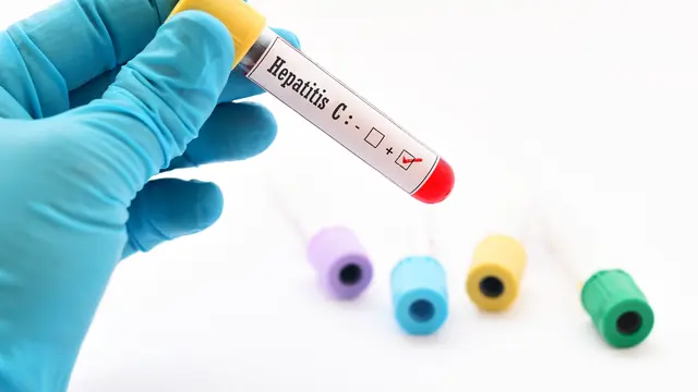 Penyebab Hepatitis (sumber: iStock)