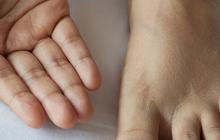 12 Cara Menghilangan Bekas Luka dengan Cepat dan Efektif, Lakukan Langkah Berikut