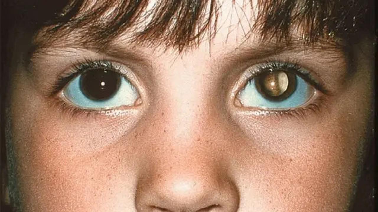 Tanda-Tanda Retinoblastoma pada Anak Sejak Dini