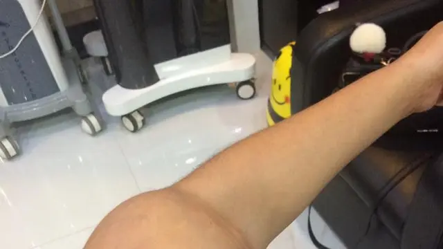 [Bintang] Satu Tangan Diamputasi karena Kanker, Gadis Cantik Ini Berbagi Kisah Hidupnya di Media Sosial