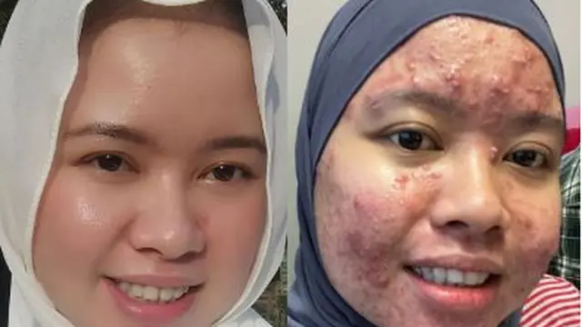 Sempat Disangka Terkena Guna-Guna, Wajah Wanita Ini Berubah Jerawatan Parah
