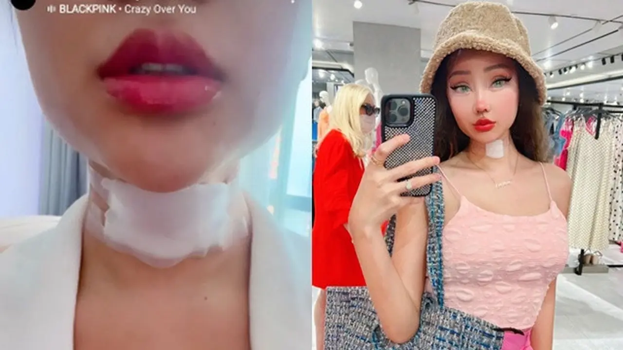 6 Potret Hasil Operasi Potong Jakun Lucinta Luna, Belum Bisa Menelan