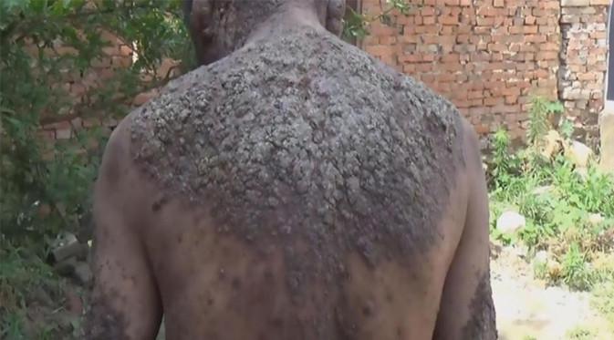 Akibat penyakit kulit aneh, Li harus hidup terisolasi. (Foto: AsiaWire)