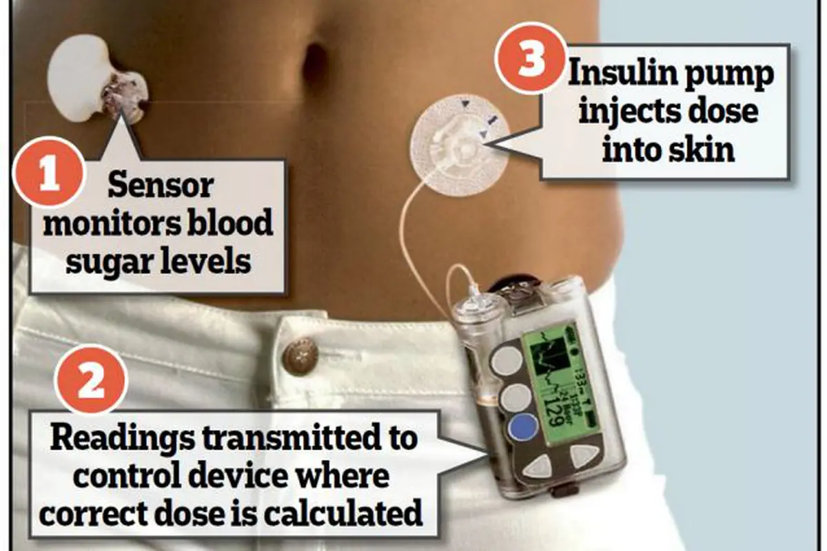 Diabetesi Dapat Gunakan Alat Ini Untuk Hentikan Suntikan Insulin