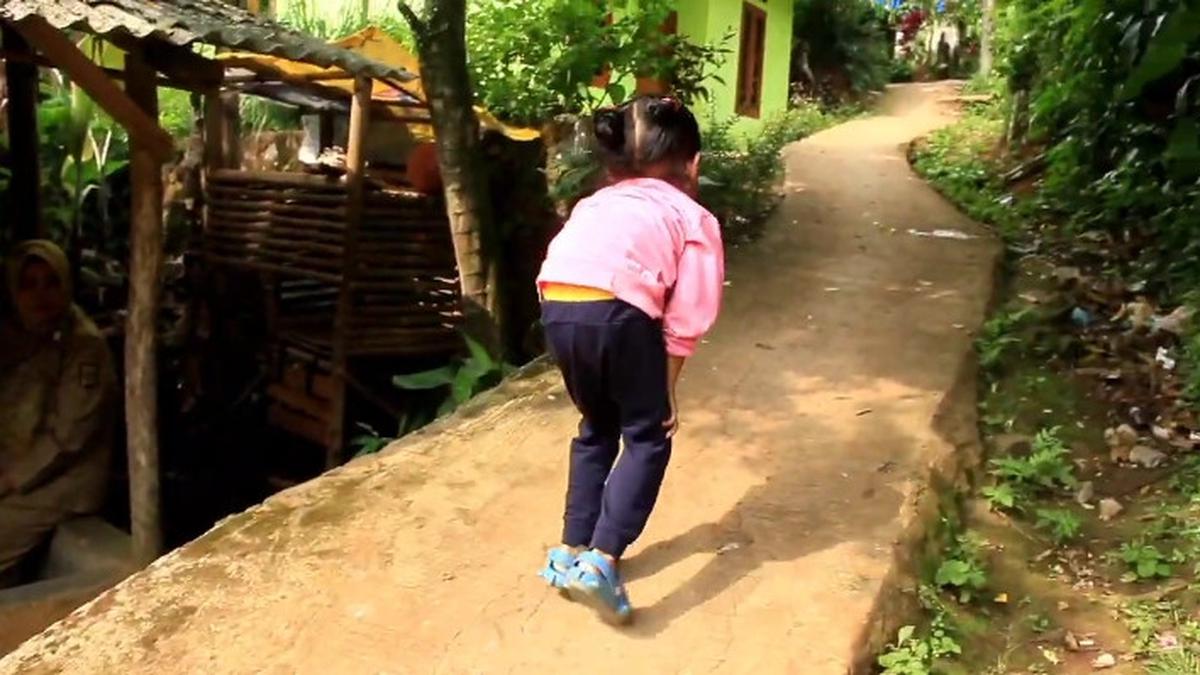 Kisah Pilu Balita 5 Tahun di Sukabumi, Jalan Bungkuk Diduga Idap TB Tulang Tak Mampu Berobat