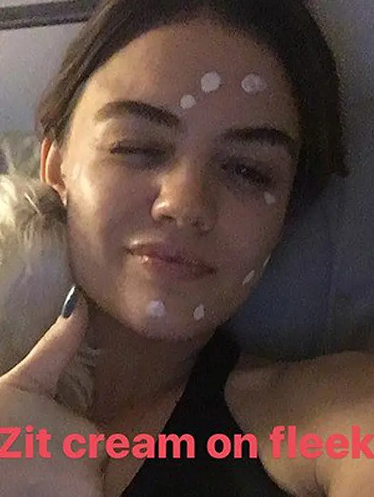 Lucy Hale pun melakukan hal serupa. Mengunggah foto wajah yang tengah dalam masa perawatan karena jerawat. (instagram/HollywoodLife)