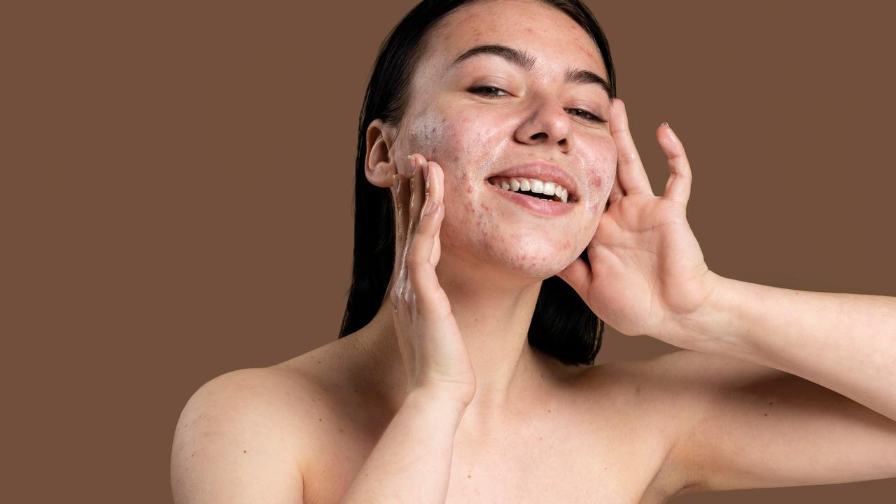 wanita berjerawat