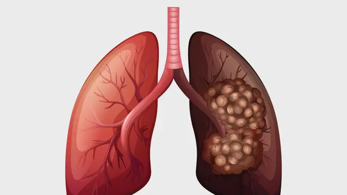 Kanker Paru-paru - KlikDokter.com (BlueRingMedia/Shutterstock)