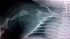 Salah satu bayi di Gwent, South Wales, Inggris, yang berukuran besar terperangkap di jalur lahir saat proses persalinan dan kesulitan bernapas.Demi menyelamatkan Sang Bayi yang bernama Poppy Screen tim medis akhirnya membuat keputusan untuk mematahka...