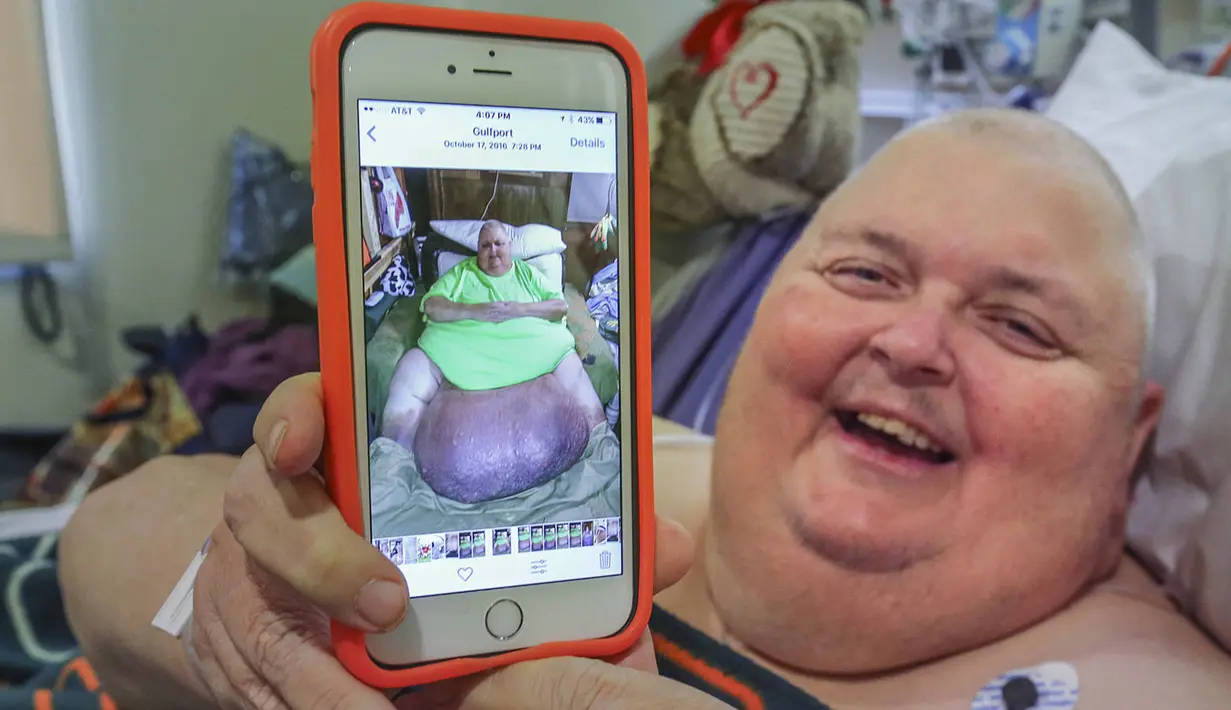 Roger Logan menunjukkan foto dirinya sebelum operasi pengangkatan tumor seberat 58,97 kg yang tumbuh selama 12 tahun terakhir di dalam perutnya, di RS Bakersfield Memorial, California, 2 Februari 2017. (Henry A. Barrios/The Bakersfield Californian via AP)