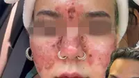 Kulit Wajah Seorang Perempuan Terbakar Usai Nekat Pakai Skincare Kedaluwarsa