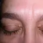 Bukan cuma faktor genetik, xanthelasma juga bisa muncul karena kadar kolesterol yang tinggi.
