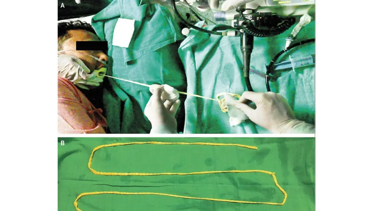 Cacing pita babi yang dikeluarkan dari usus seorang pria. (Live Science)