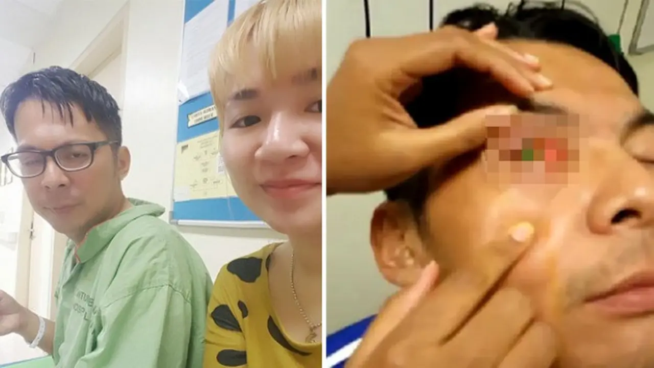 Ngeri, Mata Pria Ini Buta Karena Pakai Kontak Lensa Saat Tidur