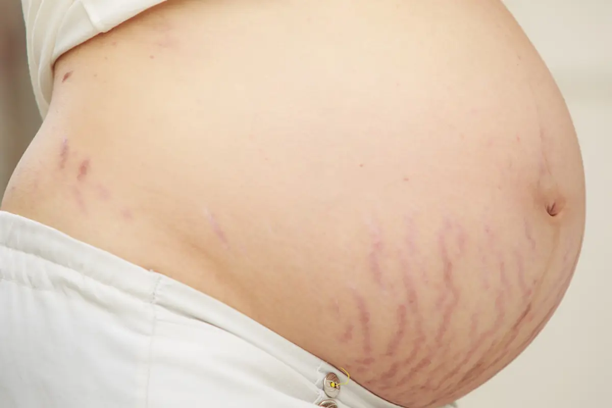 Stretch Mark - Vania