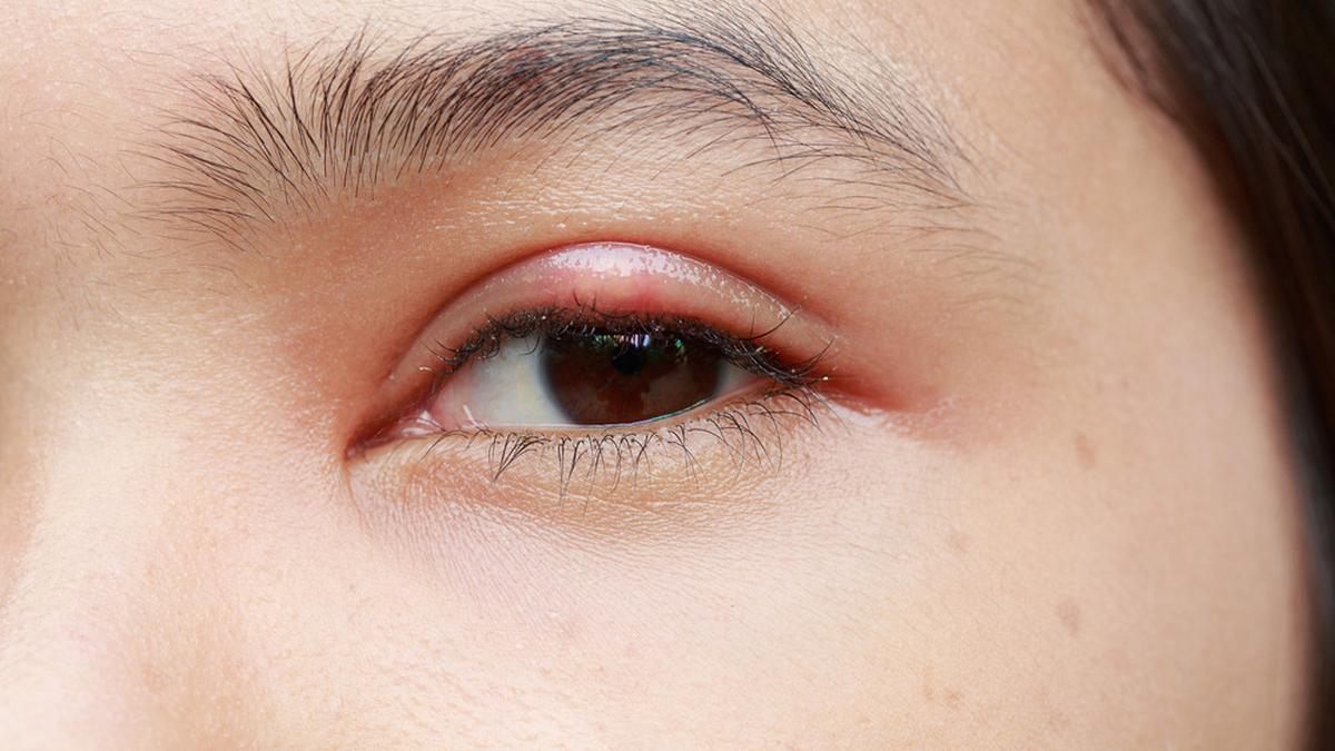 4 Cara Mengatasi Mata Bintitan - Health Fimela.com