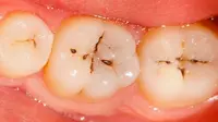 Ada kemungkinan penggunaan bakteri bermanfaat ini untuk menciptakan suplemen yang dapat mencegah gigi berlobang.