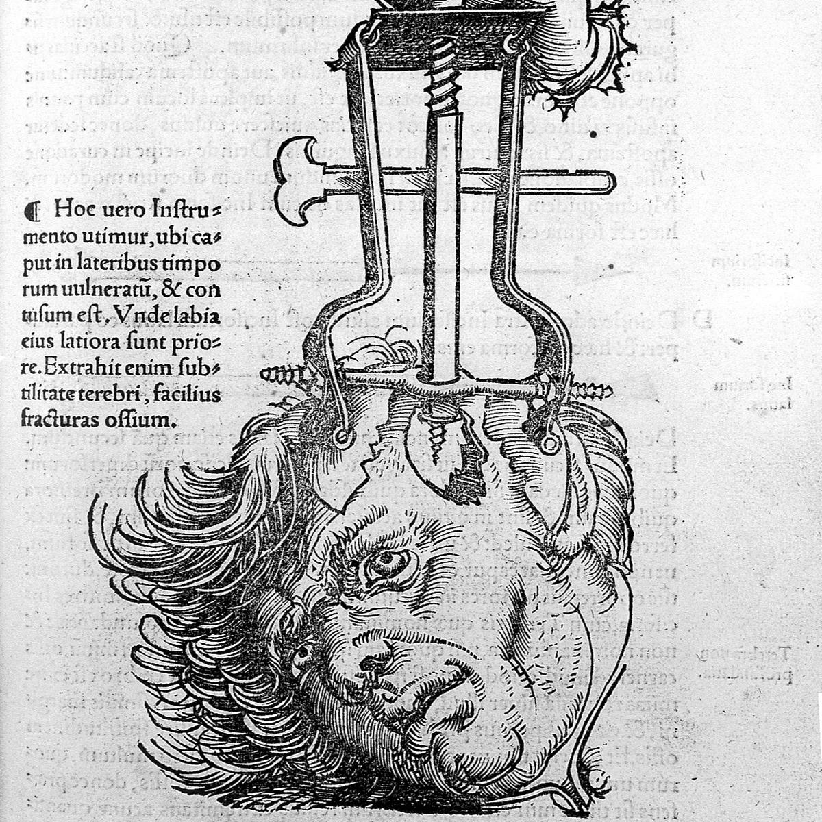 Trepanasi