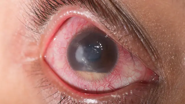 [Bintang] Ngaku Suka Pakai Softlens, Hati-hati Jangan Terjadi 4 Hal Ini