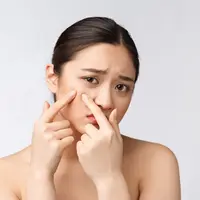 Jerawat dan penyebabnya (Foto: Freepik.com)