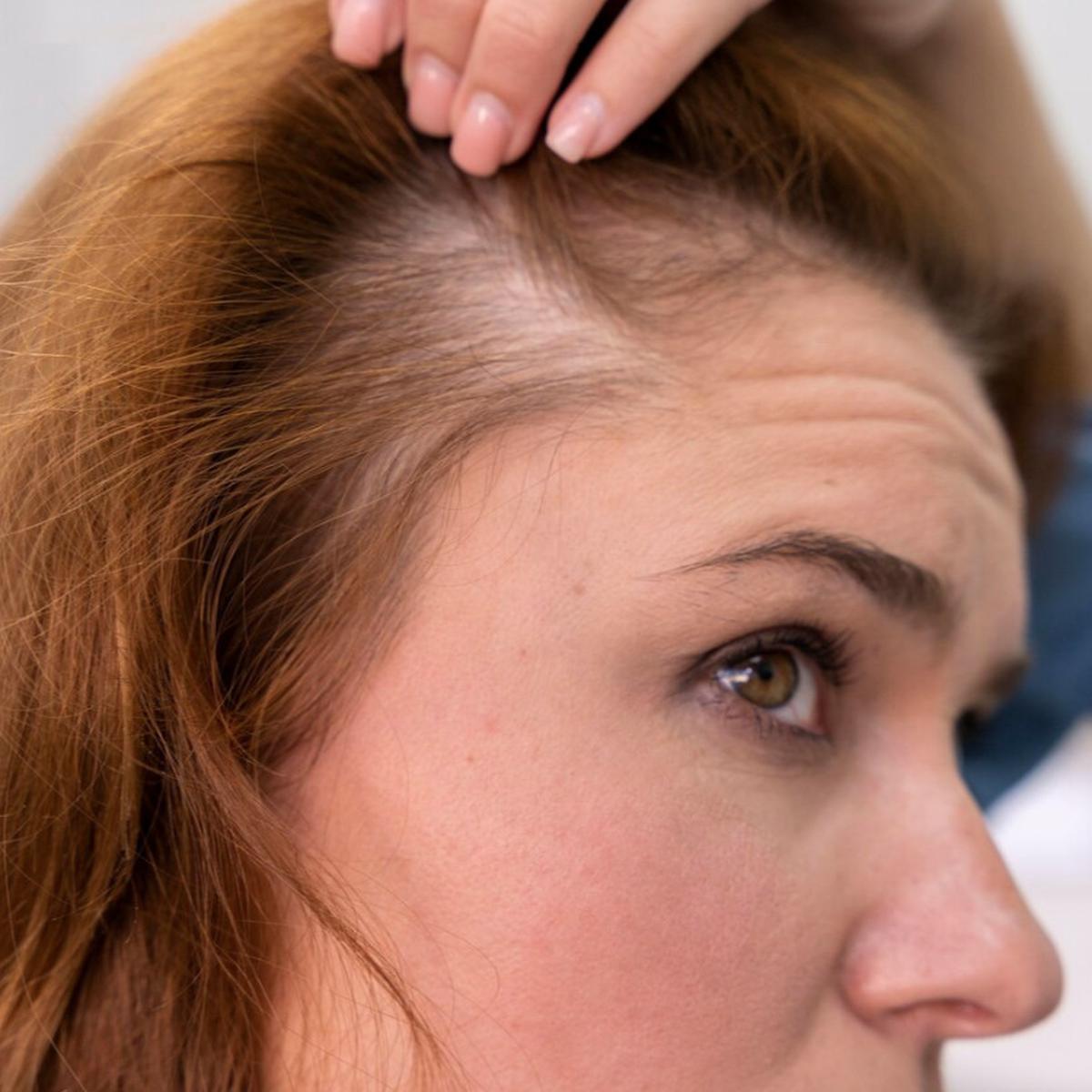 Rambut Rontok Akibat Stres? Temukan Solusi dan Cara Pencegahannya!
