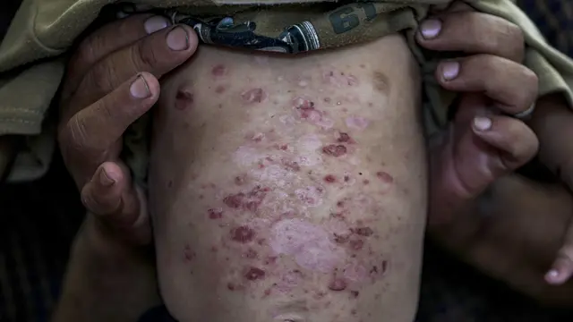 Penyakit kulit dan virus yang mengancam jiwa di Gaza akibat air kotor