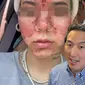 Kulit wajah seorang perempuan terbakar usai nekat pakai skincare kedaluwarsa. (dok. tangkapan layar video TikTok @doctoryoun/https://www.tiktok.com/@doctoryoun/video/7375325708547116330)