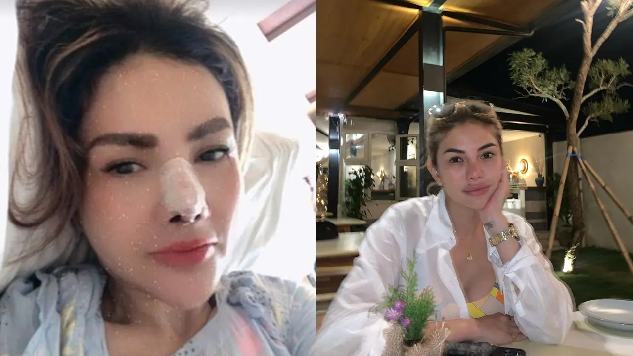 Artis Ketagihan Operasi Plastik