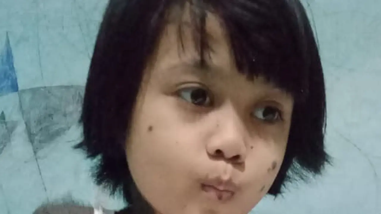 Ratna Maya sejak lahir mengalami kelainan pigmen kulit butuh uluran tangan dari para dermawan (Liputan6.com/Ahmad Adirin)
