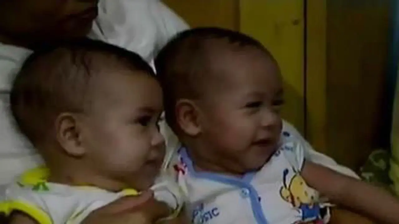 Bayi Kembar Siam