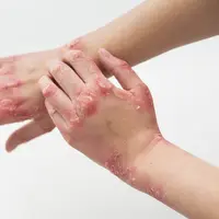 penyakit eksim./copyright. pexels/