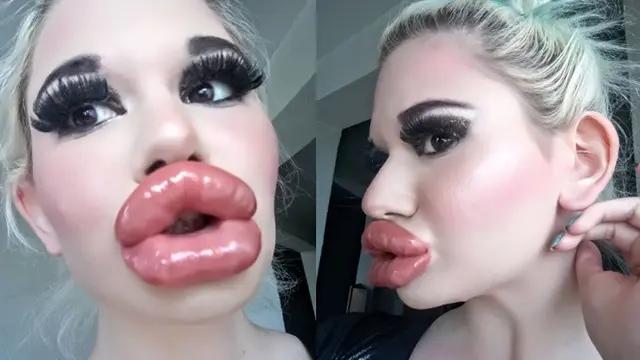 Lakukan 20 Kali Injeksi, Ini 5 Potret Transformasi Wanita Bibir Terbesar