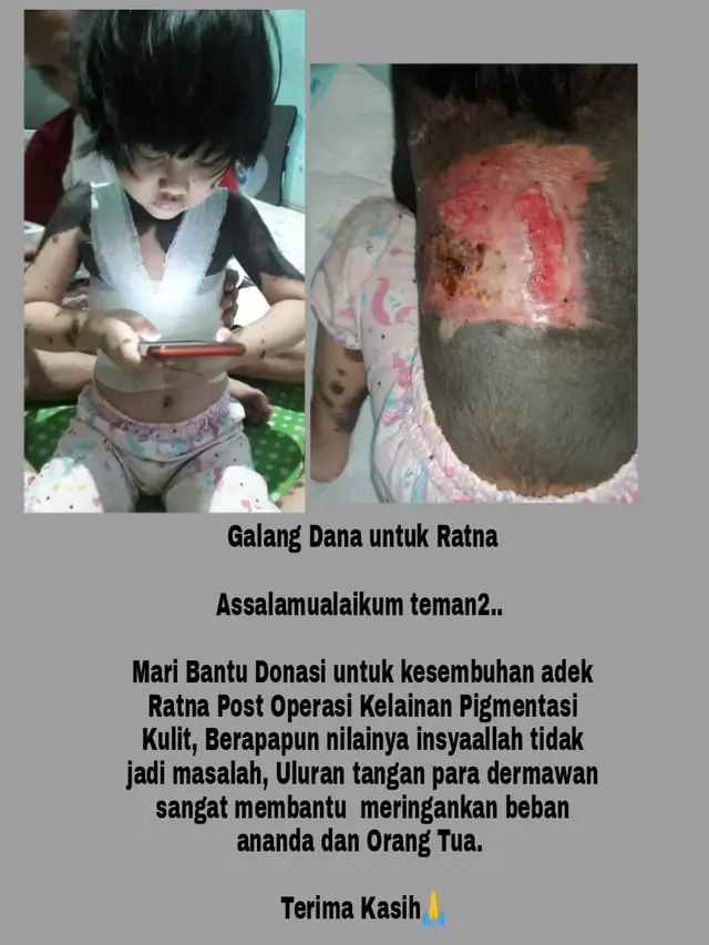 Ratna Maya sejak lahir mengalami kelainan pigmen kulit butuh uluran tangan dari para dermawan (Liputan6.com/Ahmad Adirin)