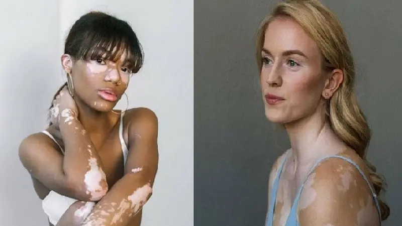 model vitiligo