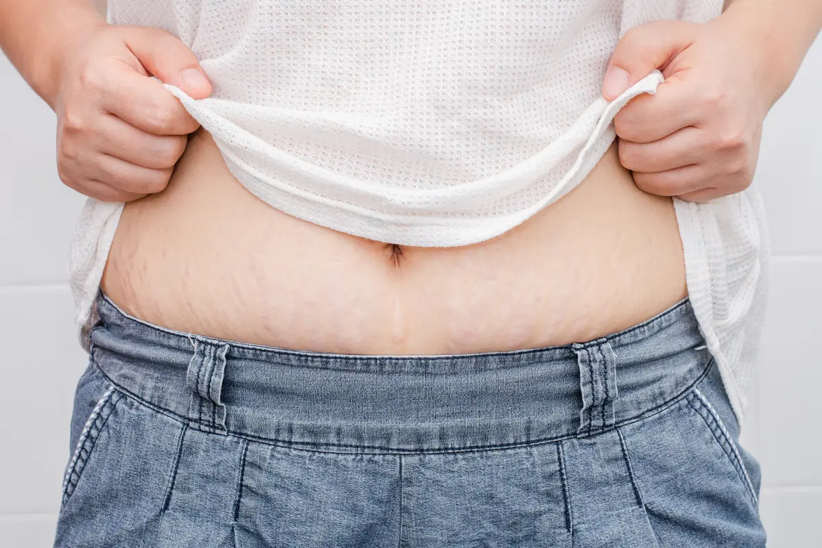 Stretch marks (iStock)