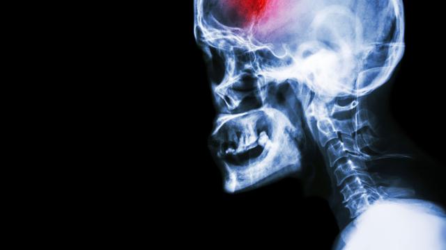 Ilustrasi stroke (iStockphoto)