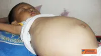Perut Terus Membesar, Raehan Tak Mampu Berobat