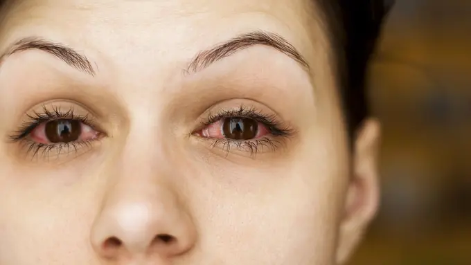 Stop Pakai Bulu Mata Palsu! Berbahaya