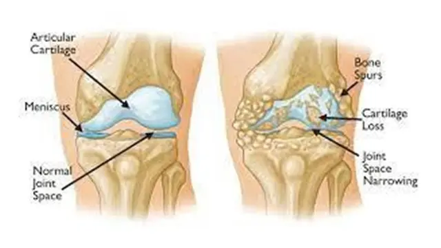 Kenali Lebih Dini Osteoporosis dan Osteoarthritis