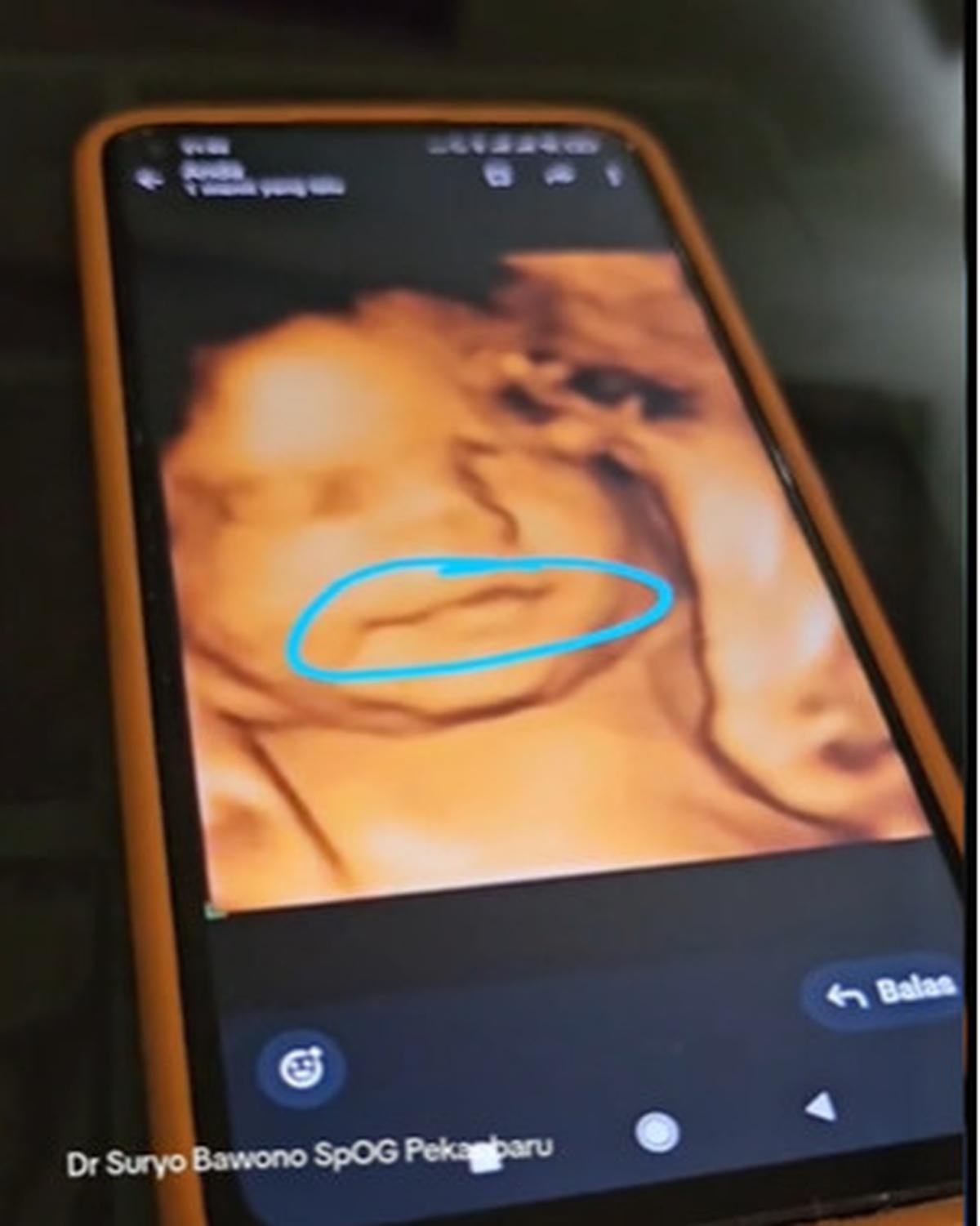 Janin 9 Bulan Hilang