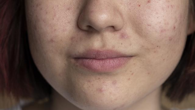 Ilustrasi wajah bruntusan