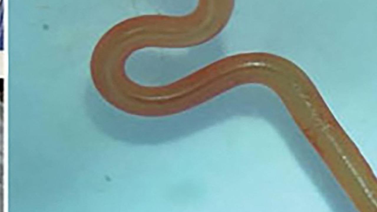 Kasus Pertama di Dunia, Cacing Hidup Berukuran 8 Cm Ditemukan dalam Otak Perempuan Australia