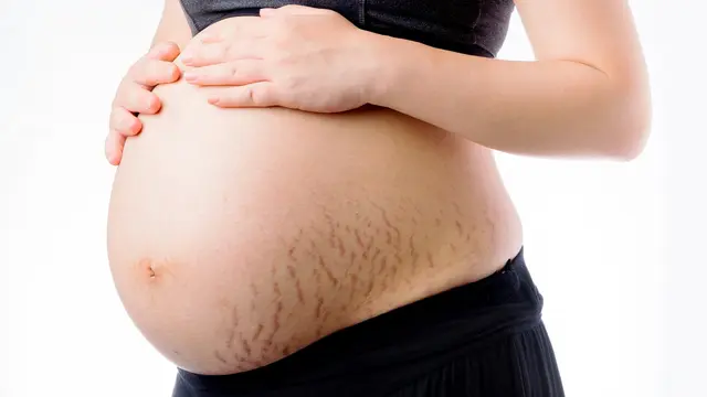 Stretch Marks