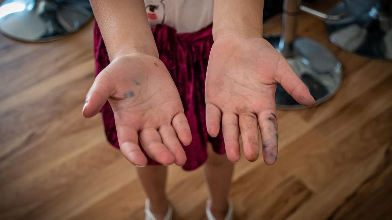 3. Tinea manum