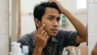 Apakah Bruntusan Bisa Hilang Sendiri? Ini Penjelasan dan Faktanya