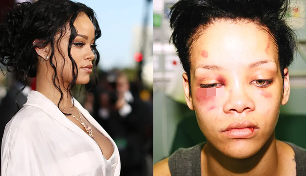 Rihanna menjadi korban kekerasan fisik yang dilakukan oleh mantan kekasihnya Chris Brown. Foto-foto Rihanna dengan wajah memar dan bengkak pun tersebar di internet. (Destination Femme)