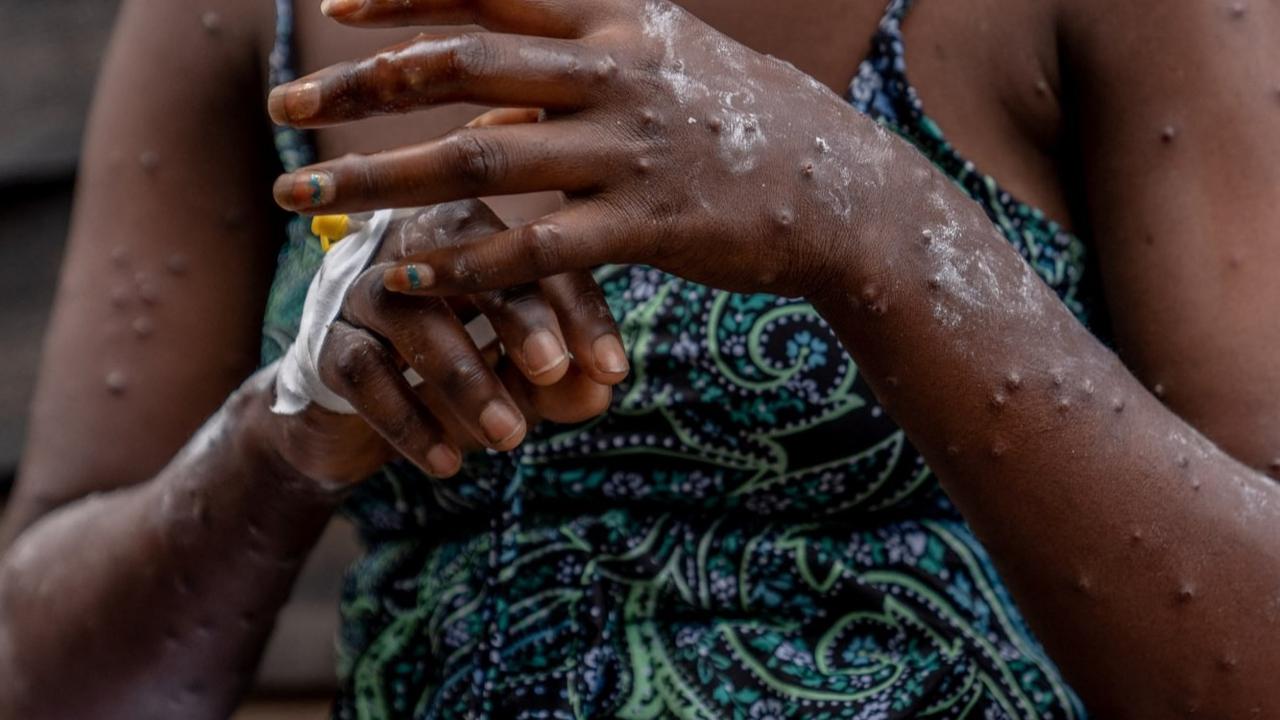 Wabah Mpox atau Cacar Monyet di Burundi