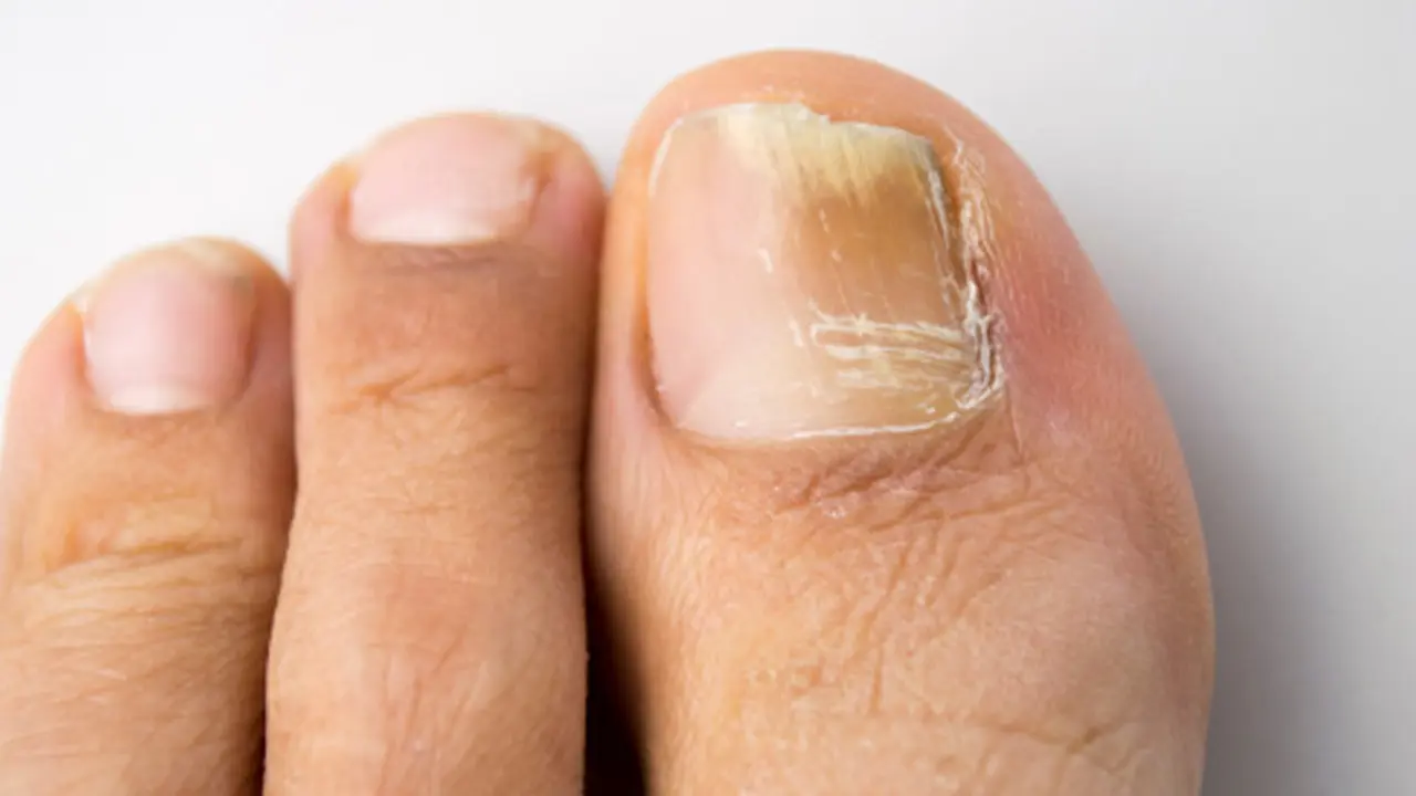 jamur kuku kaki