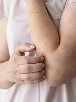 Menyembuhkan Cacar pada Anak agar Cepat Kering dan Tidak Menyebar