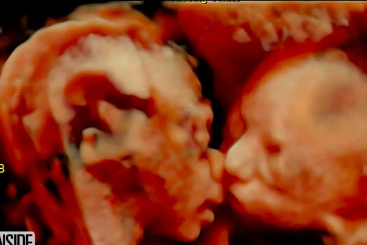 Ajaib, Bayi Kembar Terlihat Berciuman Saat di USG